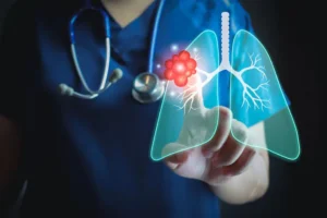 Lung-Cancer