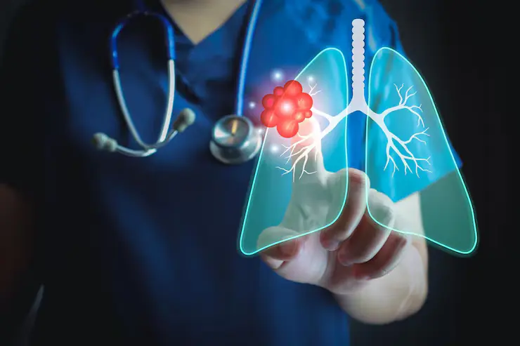 Lung-Cancer